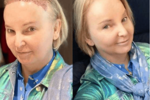india willoughby before and after hair transplant for women