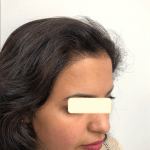 A brunette woman with her hair down wearing a beige knit jumper pictured after hair transplant procedure.