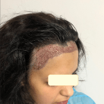 A woman with visible mark on her scalp pictured before going through hair transplant procedure, wearing a blue gown.
