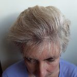 The image shows a woman with a full head of hair pictured after a hair transplant procedure.
