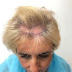 The image shows a woman with visible markings on her scalp, indicating the preparation for a hair transplant procedure.